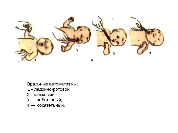 Оральные автоматизмы: 1 – ладонно-ротовой 2 - поисковый; 3 — хоботковый; 4 — сосательный.