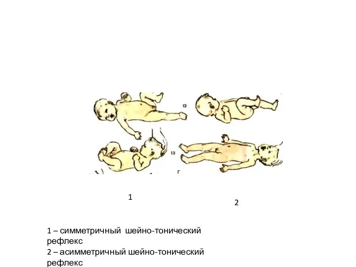 1 2 1 – симметричный шейно-тонический рефлекс 2 – асимметричный шейно-тонический рефлекс
