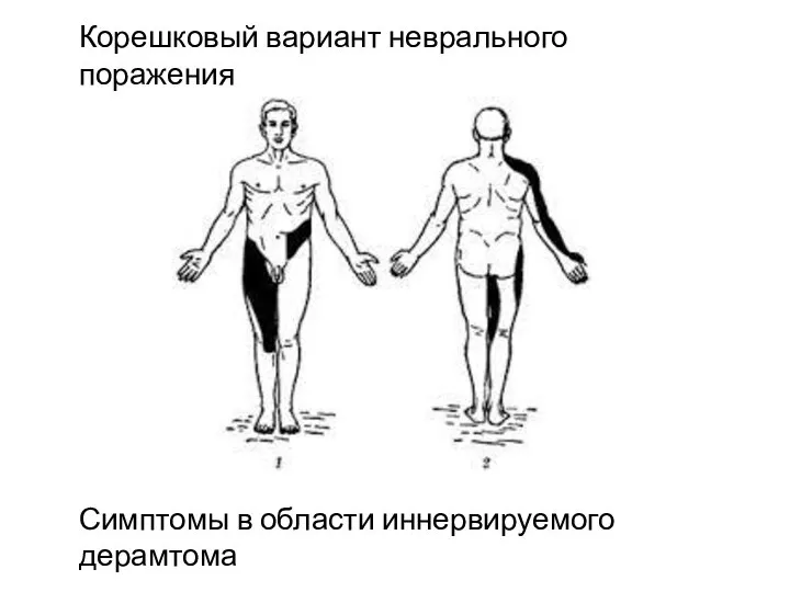 Корешковый вариант неврального поражения Симптомы в области иннервируемого дерамтома