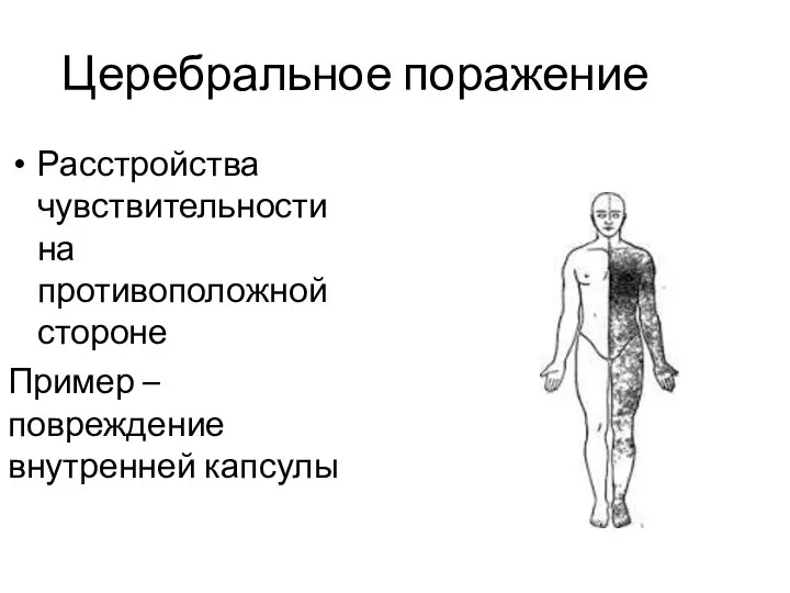 Церебральное поражение Расстройства чувствительности на противоположной стороне Пример – повреждение внутренней капсулы