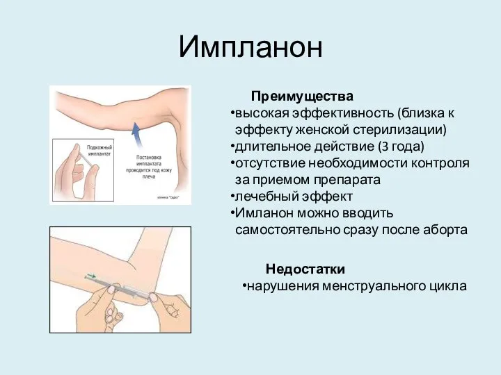 Импланон Преимущества высокая эффективность (близка к эффекту женской стерилизации) длительное действие