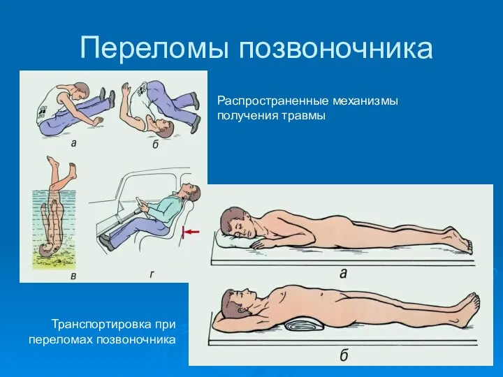 Переломы позвоночника Распространенные механизмы получения травмы Транспортировка при переломах позвоночника