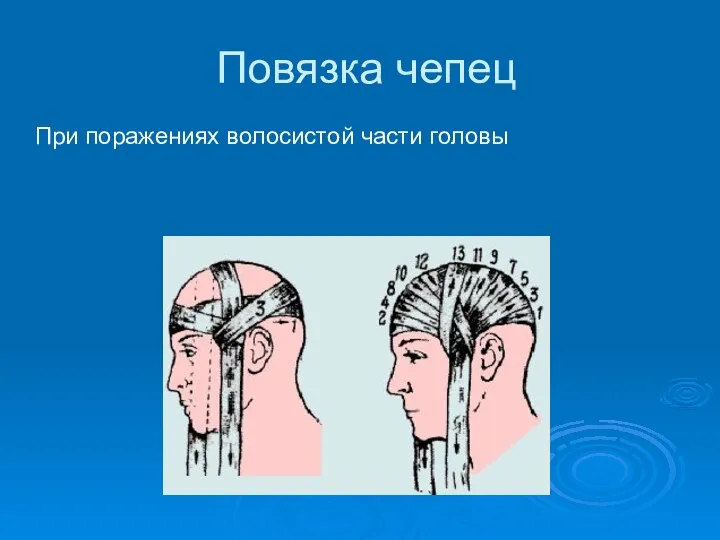 Повязка чепец При поражениях волосистой части головы