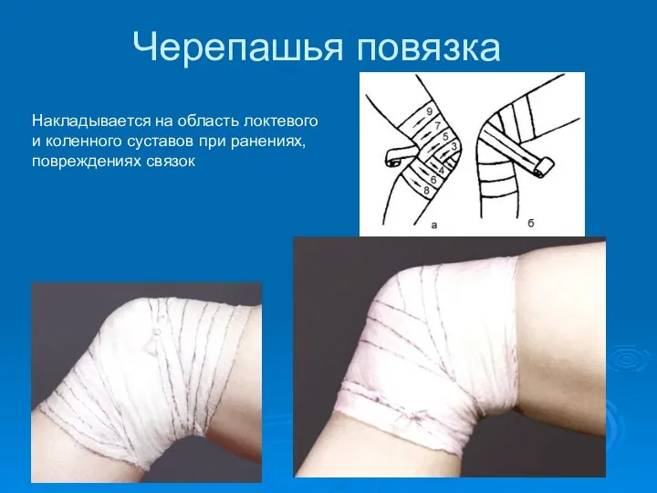 Черепашья повязка Накладывается на область локтевого и коленного суставов при ранениях, повреждениях связок