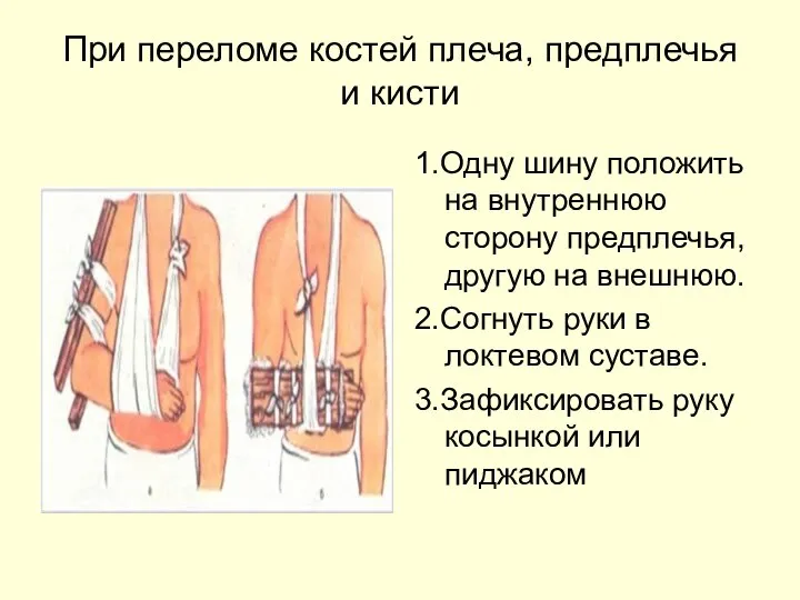 При переломе костей плеча, предплечья и кисти 1.Одну шину положить на