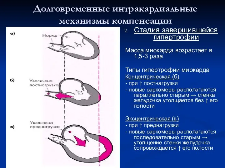 Стадия завершившейся гипертрофии Масса миокарда возрастает в 1,5-3 раза Типы гипертрофии