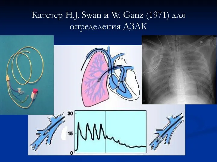 Катетер H.J. Swan и W. Ganz (1971) для определения ДЗЛК