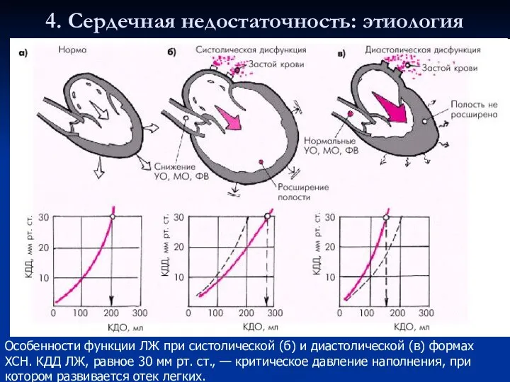 4. Сердечная недостаточность: этиология Особенности функции ЛЖ при систолической (б) и