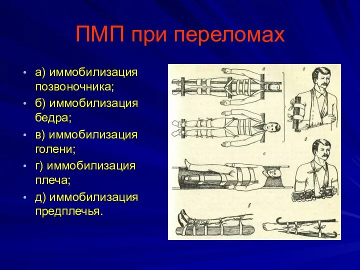 ПМП при переломах а) иммобилизация позвоночника; б) иммобилизация бедра; в) иммобилизация