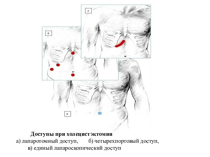 Доступы при холецистэктомии а) лапаротомный доступ, б) четырехпортовый доступ, в) единый лапароскопический доступ