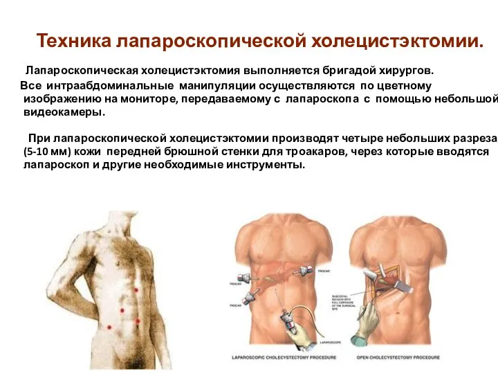 Техника лапароскопической холецистэктомии. Лапароскопическая холецистэктомия выполняется бригадой хирургов. Все интраабдоминальные манипуляции