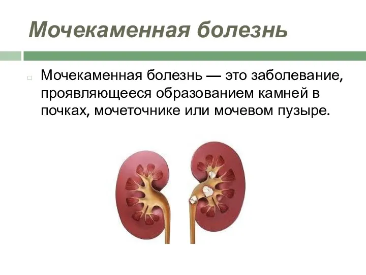 Мочекаменная болезнь Мочекаменная болезнь — это заболевание, проявляющееся образованием камней в почках, мочеточнике или мочевом пузыре.