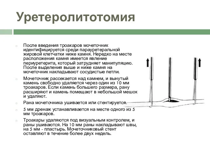 Уретеролитотомия После введения троакаров мочеточник идентифицируется среди парауретеральной жировой клетчатки ниже