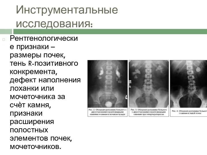 Инструментальные исследования: Рентгенологические признаки – размеры почек, тень R-позитивного конкремента, дефект