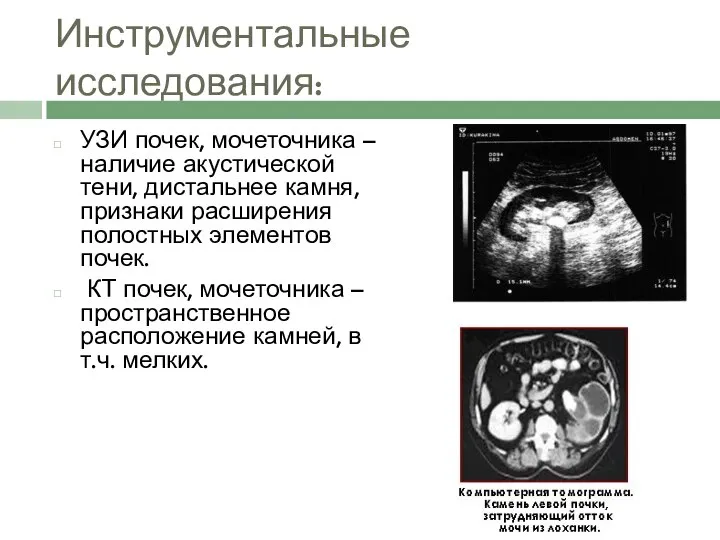 Инструментальные исследования: УЗИ почек, мочеточника – наличие акустической тени, дистальнее камня,