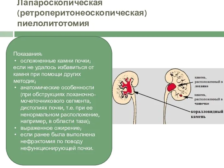 Лапароскопическая (ретроперитонеоскопическая) пиелолитотомия Показания: осложненные камни почки; если не удалось избавиться