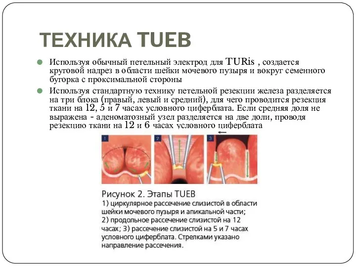 ТЕХНИКА TUEB Используя обычный петельный электрод для TURis , создается круговой