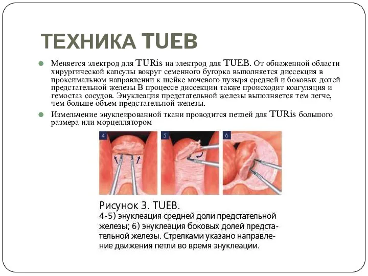 ТЕХНИКА TUEB Меняется электрод для TURis на электрод для TUEB. От