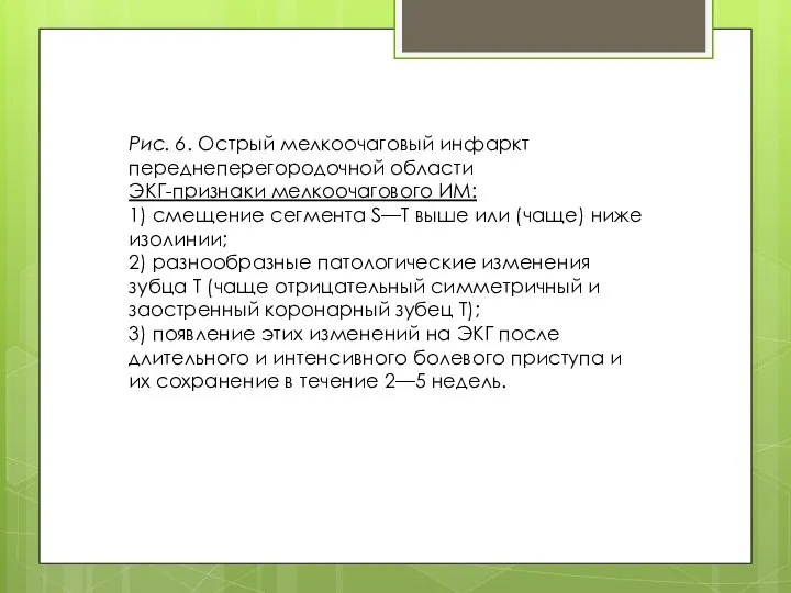 Рис. 6. Острый мелкоочаговый инфаркт переднеперегородочной области ЭКГ-признаки мелкоочагового ИМ: 1)