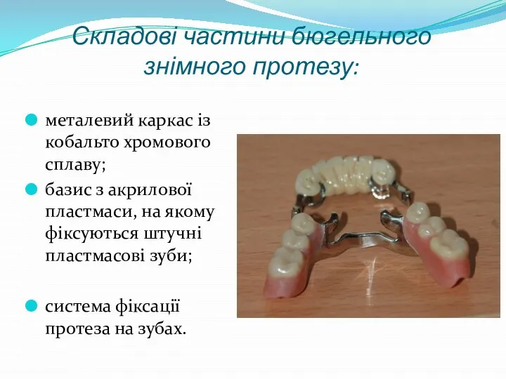 Складові частини бюгельного знімного протезу: металевий каркас із кобальто хромового сплаву;