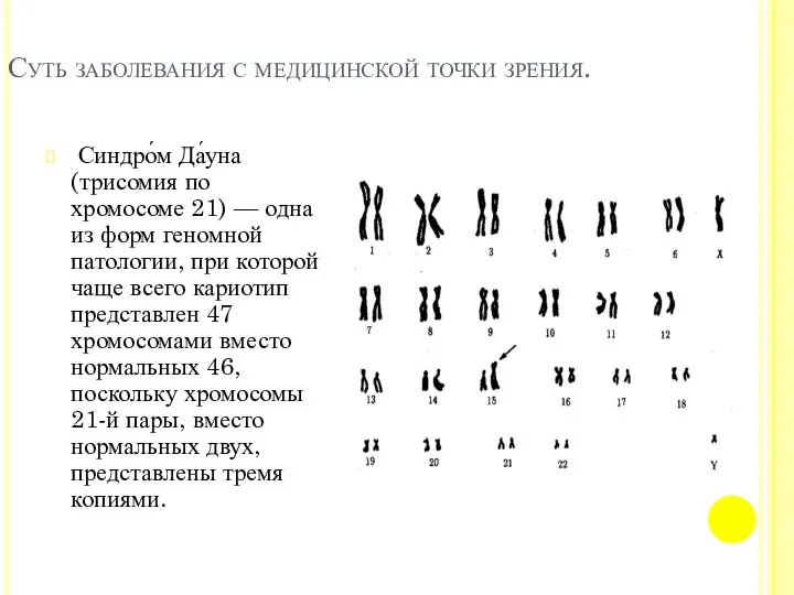 Суть заболевания с медицинской точки зрения. Синдро́м Да́уна (трисомия по хромосоме