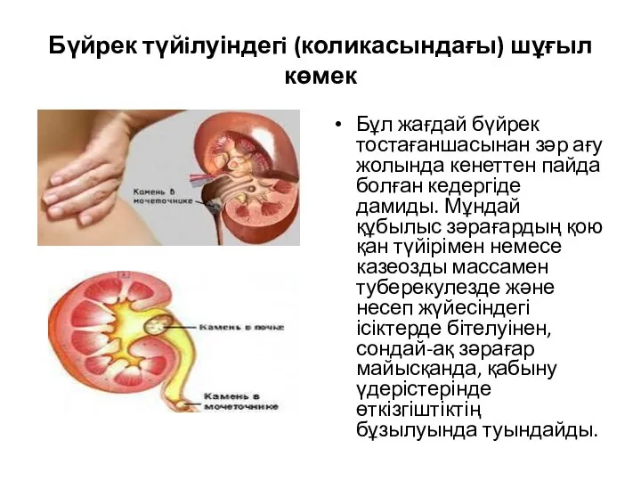 Бүйрек түйiлуіндегi (коликасындағы) шұғыл көмек Бұл жағдай бүйрек тостағаншасынан зәр ағу