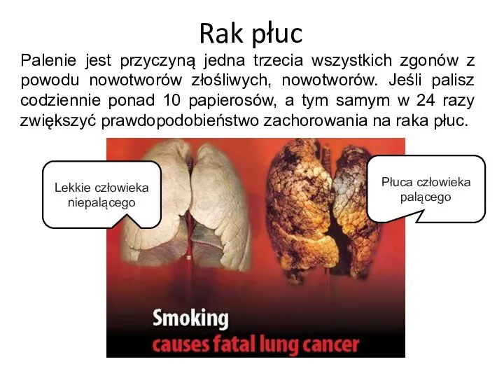 Rak płuc Palenie jest przyczyną jedna trzecia wszystkich zgonów z powodu