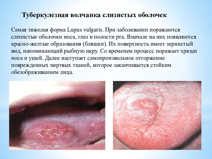 Туберкулезная волчанка слизистых оболочек Самая тяжелая форма Lupus vulgaris. При заболевании
