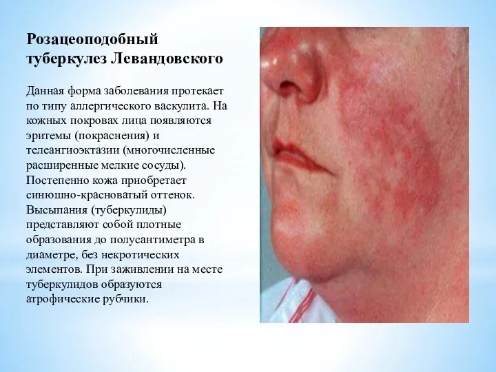 Розацеоподобный туберкулез Левандовского Данная форма заболевания протекает по типу аллергического васкулита.