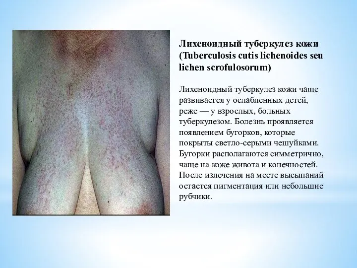 Лихеноидный туберкулез кожи (Tuberculosis cutis lichenoides seu lichen scrofulosorum) Лихеноидный туберкулез