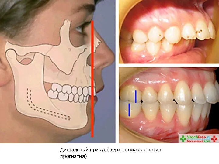 Дистальный прикус (верхняя макрогнатия, прогнатия)