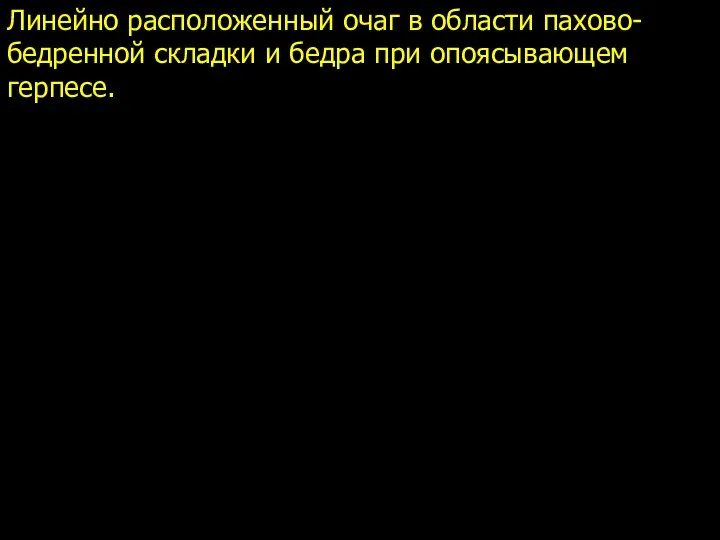 Линейно расположенный очаг в области пахово-бедренной складки и бедра при опоясывающем герпесе.