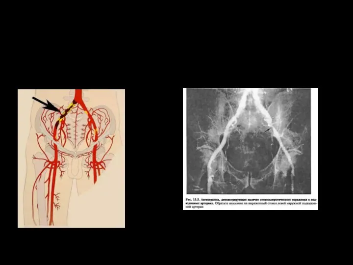 Тромбоз подвздошных артерий