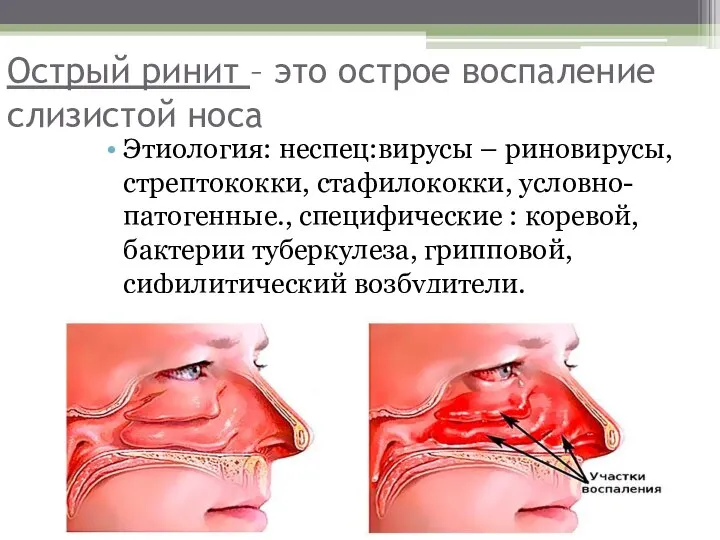 Острый ринит – это острое воспаление слизистой носа Этиология: неспец:вирусы –