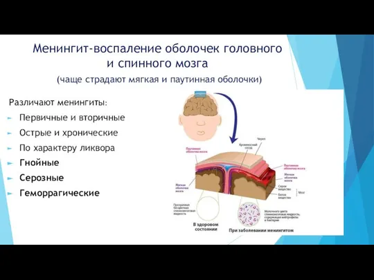 Менингит-воспаление оболочек головного и спинного мозга (чаще страдают мягкая и паутинная