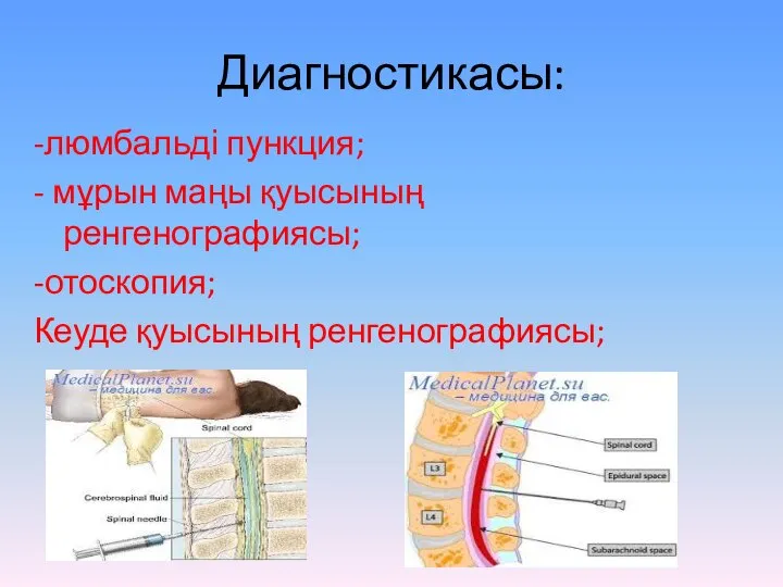 Диагностикасы: -люмбальді пункция; - мұрын маңы қуысының ренгенографиясы; -отоскопия; Кеуде қуысының ренгенографиясы;