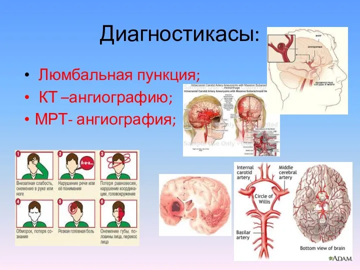 Диагностикасы: Люмбальная пункция; КТ –ангиографию; МРТ- ангиография;