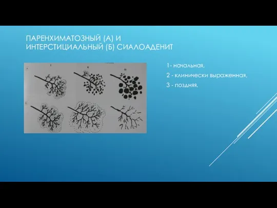 ПАРЕНХИМАТОЗНЫЙ (А) И ИНТЕРСТИЦИАЛЬНЫЙ (Б) СИАЛОАДЕНИТ 1- начальная, 2 - клинически выраженная, 3 - поздняя.