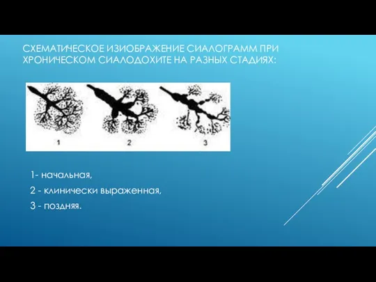 СХЕМАТИЧЕСКОЕ ИЗИОБРАЖЕНИЕ СИАЛОГРАММ ПРИ ХРОНИЧЕСКОМ СИАЛОДОХИТЕ НА РАЗНЫХ СТАДИЯХ: 1- начальная,