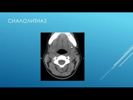 СИАЛОЛИТИАЗ