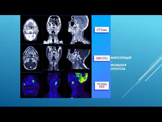 МУКОЭПИДЕР- МОИДНАЯ ОПУХОЛЬ