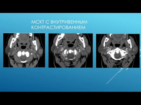 МСКТ С ВНУТРИВЕННЫМ КОНТРАСТИРОВАНИЕМ