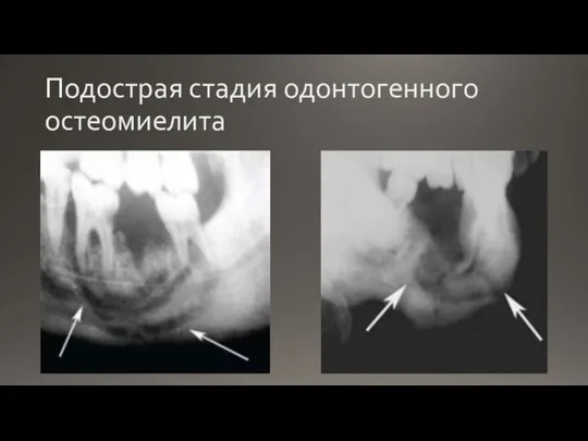 Подострая стадия одонтогенного остеомиелита