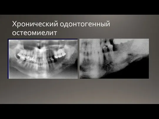 Хронический одонтогенный остеомиелит