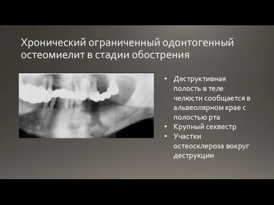 Хронический ограниченный одонтогенный остеомиелит в стадии обострения Деструктивная полость в теле