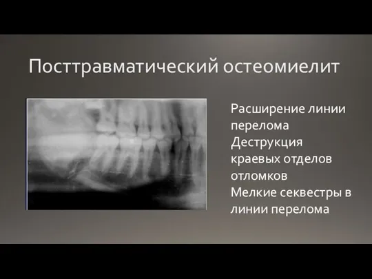 Посттравматический остеомиелит Расширение линии перелома Деструкция краевых отделов отломков Мелкие секвестры в линии перелома