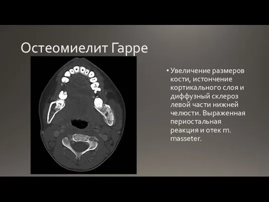 Остеомиелит Гарре Увеличение размеров кости, истончение кортикального слоя и диффузный склероз