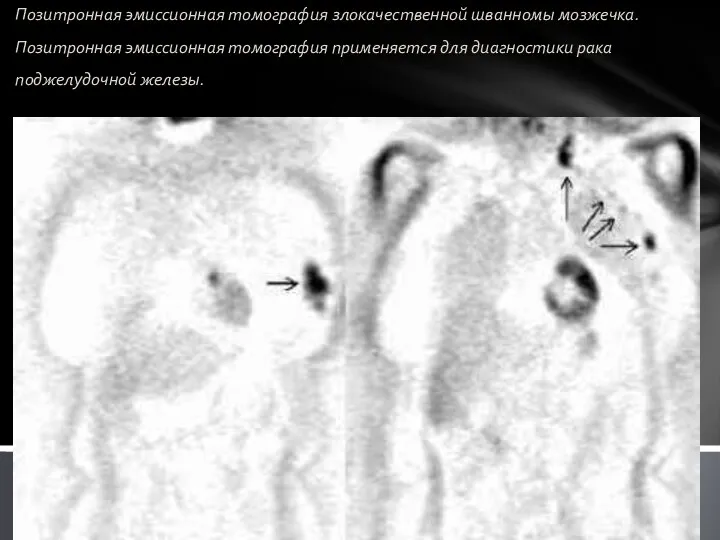 Позитронная эмиссионная томография злокачественной шванномы мозжечка. Позитронная эмиссионная томография применяется для диагностики рака поджелудочной железы.