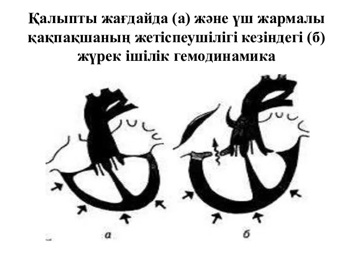 Қалыпты жағдайда (а) және үш жармалы қақпақшаның жетіспеушілігі кезіндегі (б) жүрек ішілік гемодинамика