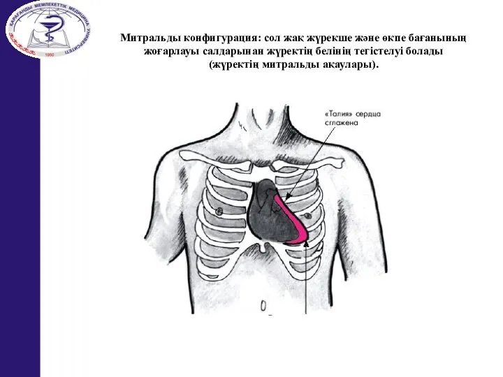 Митральды конфигурация: сол жақ жүрекше және өкпе бағанының жоғарлауы салдарынан жүректің